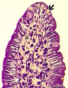 lipid malabsorption - large lipid droplets in enterocytes and propria … HE lipid malabsorption - large lipid droplets in enterocytes and propria … HE